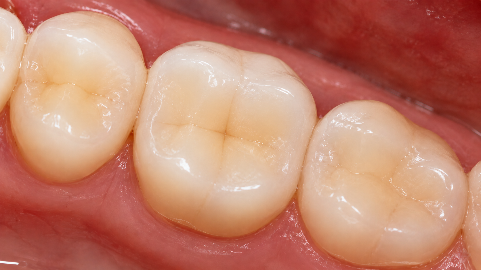 After Restorative Treatment